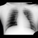 Gunshot wound, thorax, chest wall: X-ray - Plain radiograph